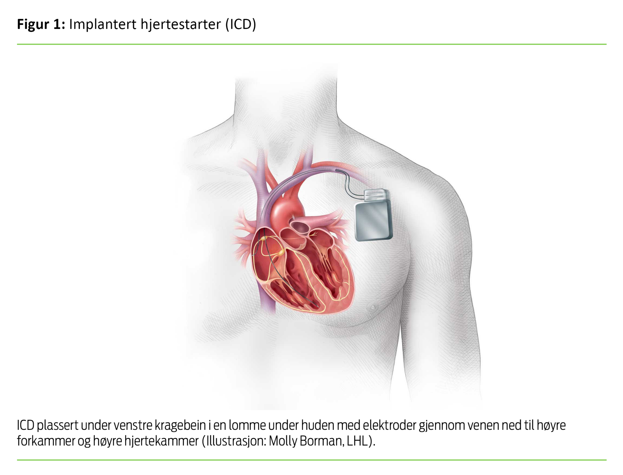 Figur 1 Figur 1. Implantert hjertestarter (ICD)