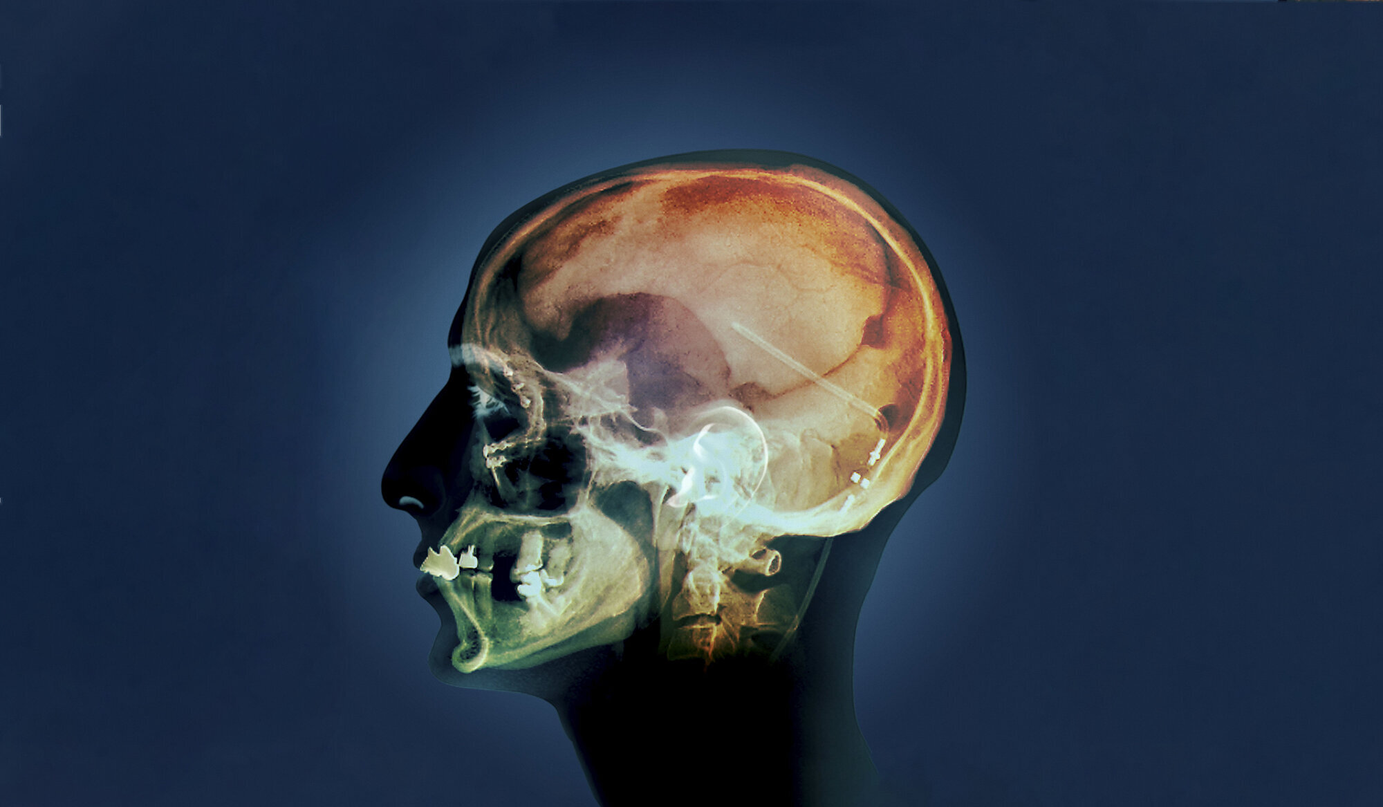 Person med hydrocephalus med innoperert shunt. Bildet viser et røntgenbilde av et hode sett fra siden, der man kan se shunten inne i hodet.