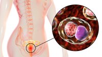 Bakterien chlamydia trachomatis har infisert cellene i livmorhalsen 3D-illustrasjonen viser en kvinne med nærbilde av bakterien chlamydia trachomatis, som har infisert cellene i livmorhalsen