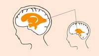 VANNHODE: Hydrocephalus (vannhode) er en tilstand med økt hjernevæske og utvidelse av hjernens naturlige hulrom, ventrikkelsystemet. Kilde: Oslo-universitetssykehus. Illustrasjon: Monica Hilsen