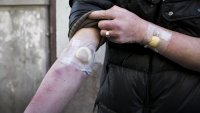 Arm Bildet viser armen til en person som har injisert rusmidler i en lengre periode