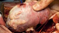 Bilde viser transplantasjon av nyre Bilde viser transplantasjon av nyre